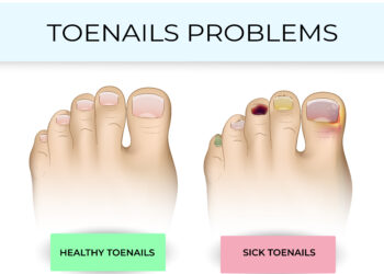 What Kills Toenail Fungus Instantly