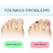 What Kills Toenail Fungus Instantly