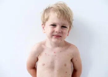 Child with chickenpox rash, a common symptom used in the diagnostic evaluation of chickenpox