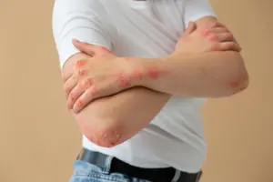 Back view showing multiple red blisters and rashes typical of herpes zoster infection