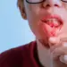 Mouth Ulcers