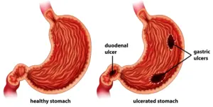 This image compares a healthy stomach with an ulcerated stomach, showing the location of gastric and duodenal ulcers that occur in peptic ulcer disease.