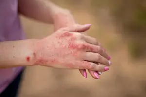 A close-up of a hand showing red, irritated patches of eczema and psoriasis, illustrating how Batana Oil for Eczema and Psoriasis may help soothe inflammation, reduce dryness, and support skin healing.