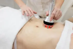 A practitioner performing a radiofrequency skin tightening procedure on a patient's abdomen to treat an apron belly and loose skin
